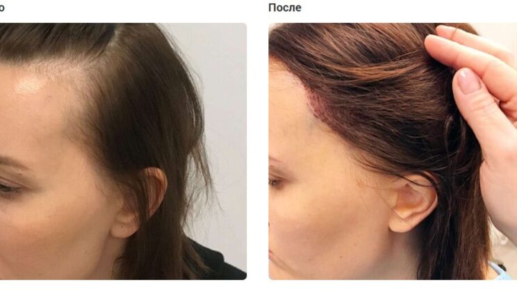 Пересадка волос в Москве: когда FUE — это правильный выбор?