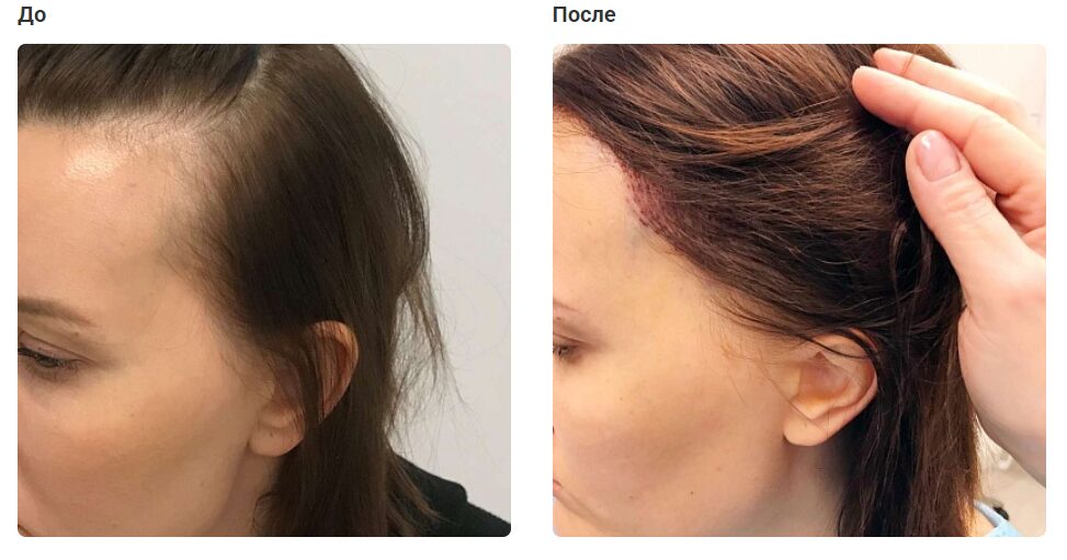 Пересадка волос в Москве: когда FUE — это правильный выбор?